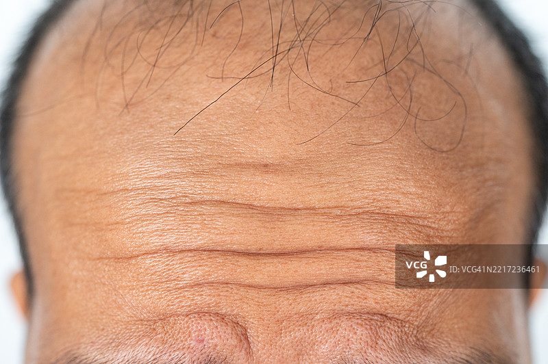 男性额头皱纹的特写镜头。压力会导致皮肤中的蛋白质发生变化，降低皮肤的弹性。图片素材