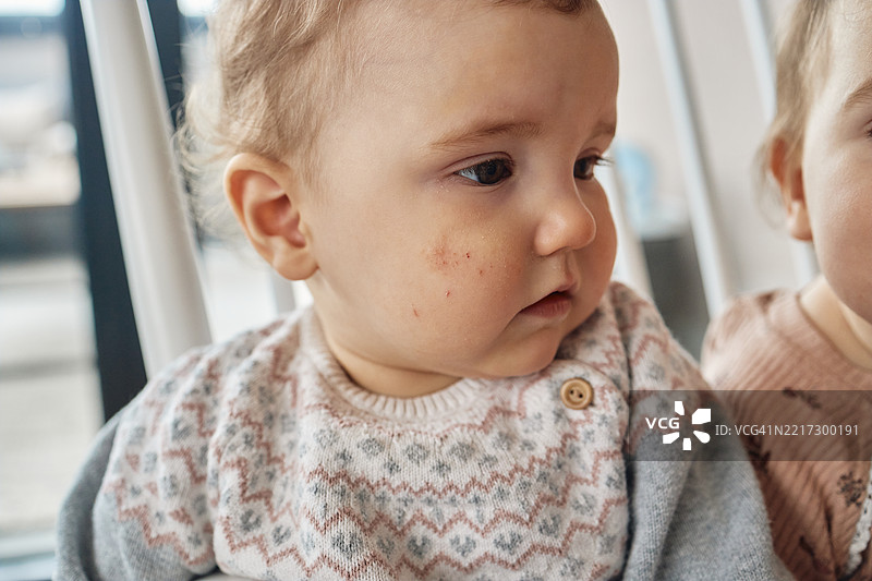 患有湿疹的婴儿女孩图片素材