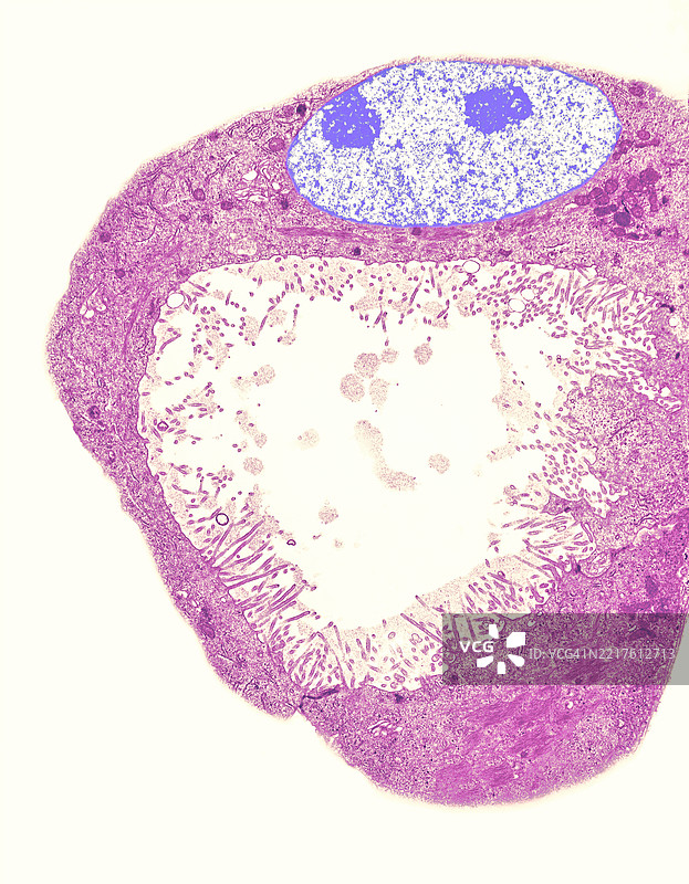 胃中的环状细胞癌图片素材