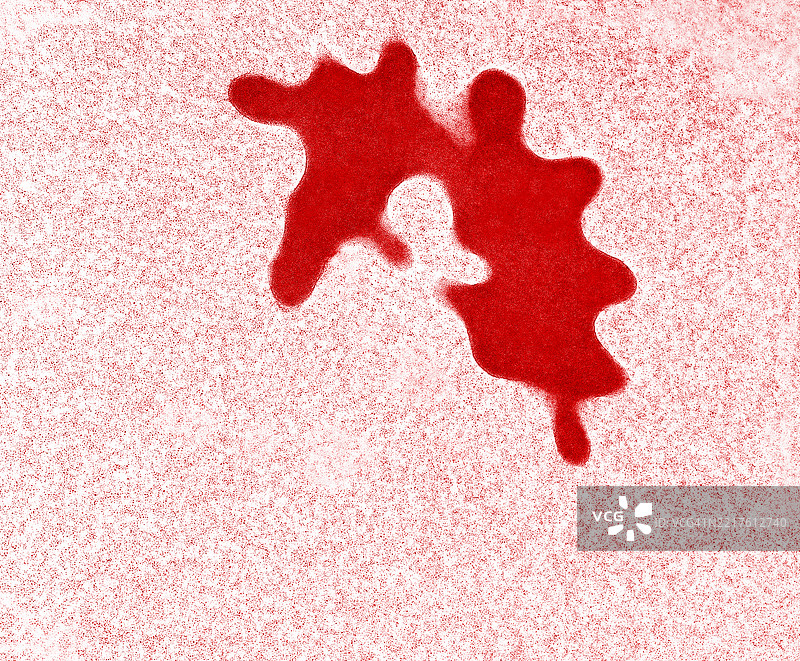 血液中的棘红细胞增多症图片素材