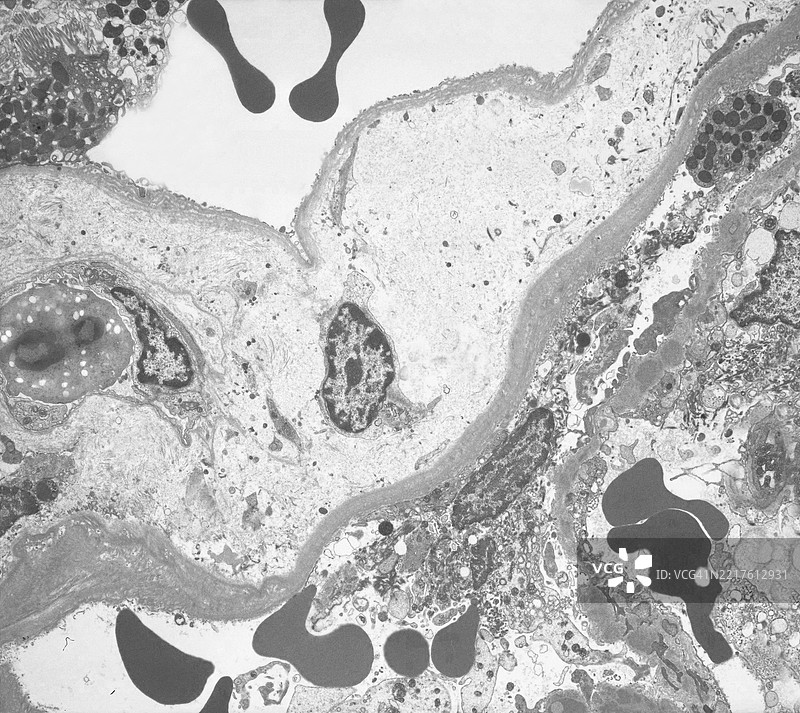 尿液中的血尿图片素材