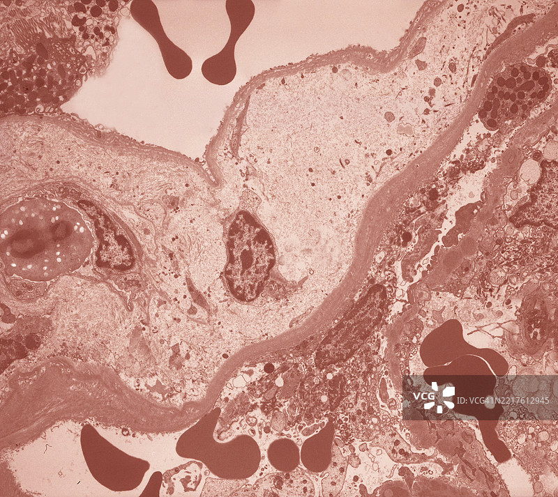 尿液中的血尿图片素材