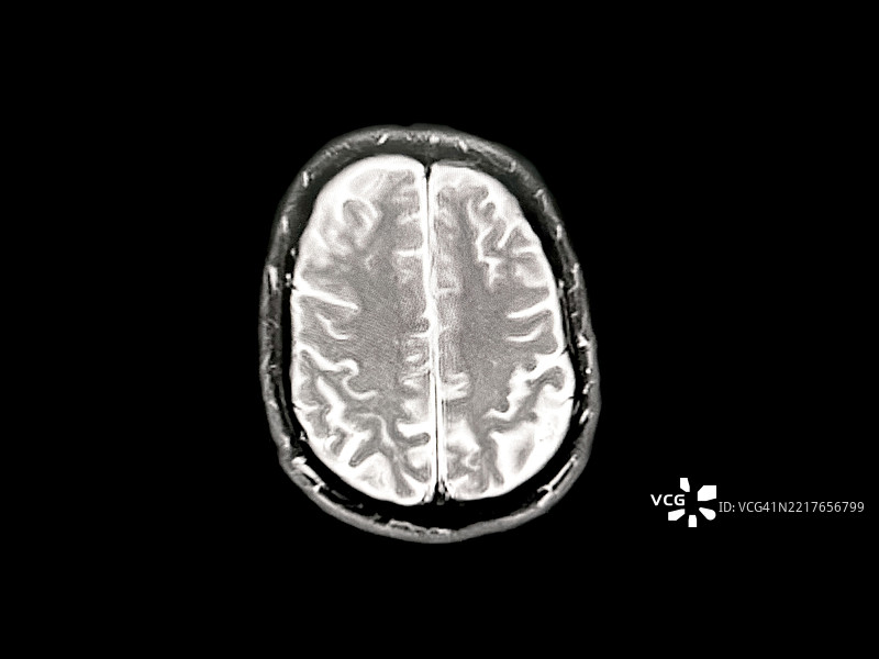 MIR脑扫描显示早期痴呆/阿尔茨海默病图片素材