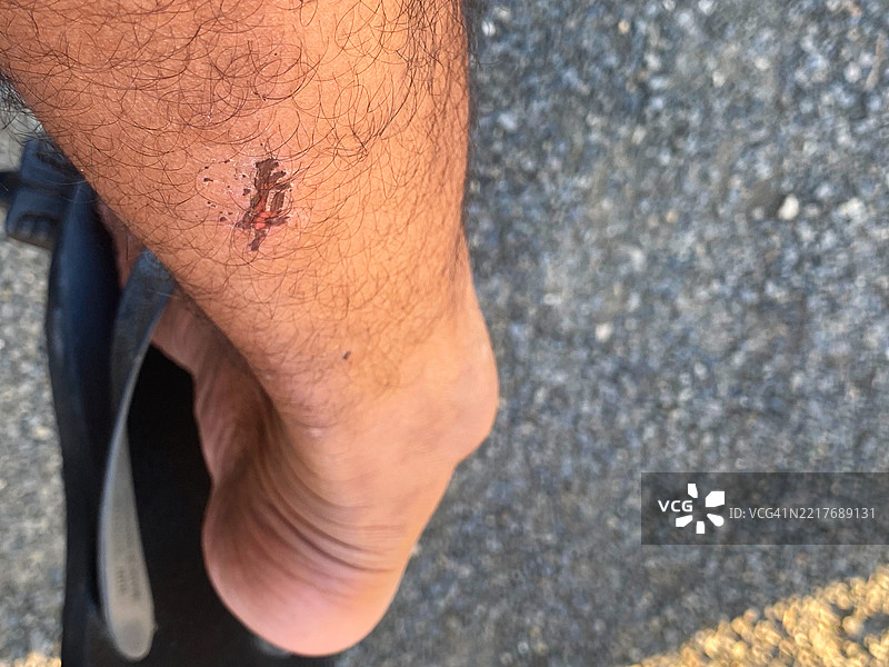脚部皮肤表面的干燥伤口图片素材