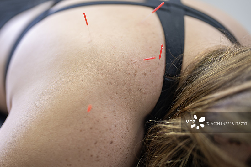 针对肩部的针灸疗程，旨在放松和缓解疼痛图片素材