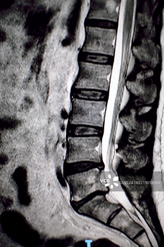 在无对比剂的腰椎MRI中发现疝气图片素材