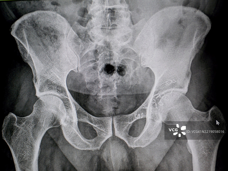 在腰骶脊柱的正面X光片上发现疝气图片素材