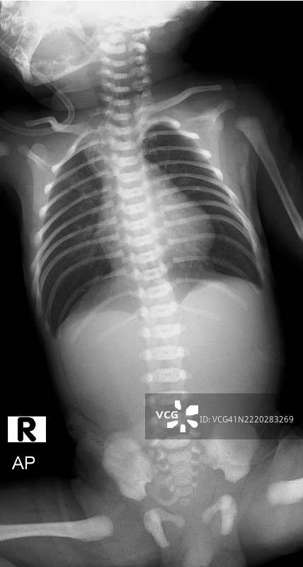 食管闭锁和气管食管瘘，X光片图片素材