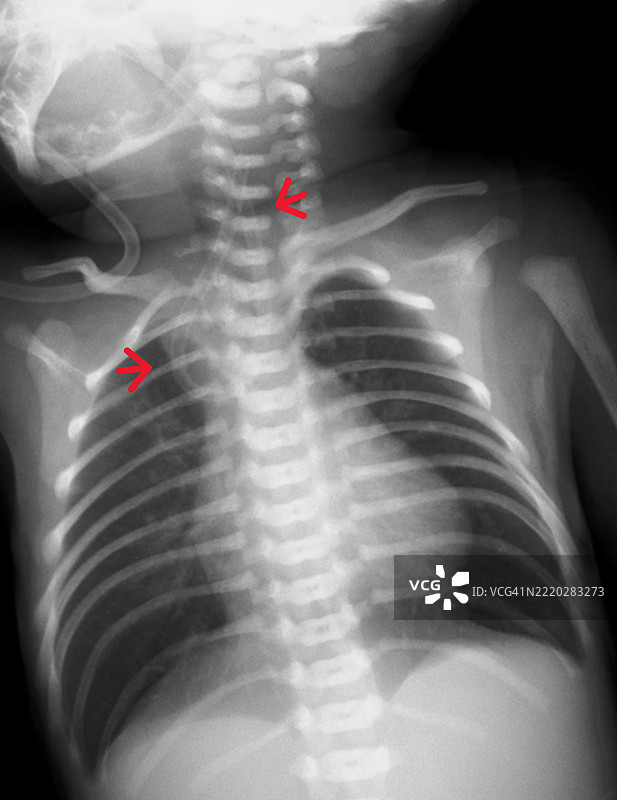 食管闭锁和气管食管瘘，X光片图片素材