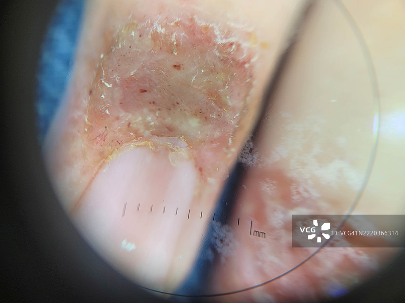 用于教育目的的皮肤病变的皮肤镜（放大）图像图片素材