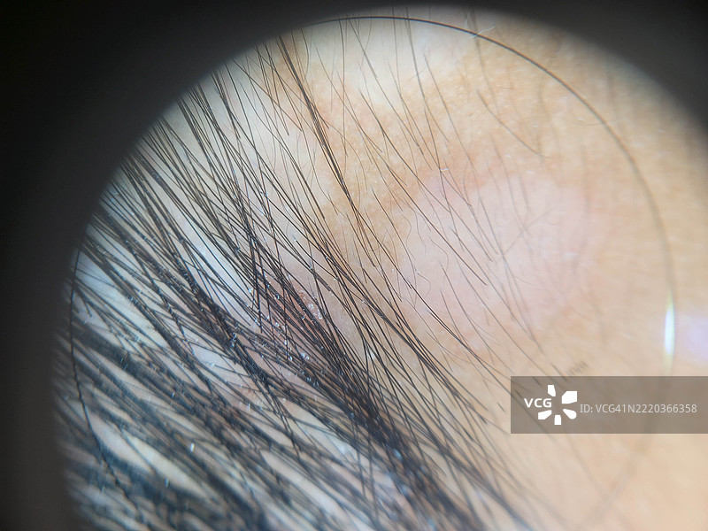 用于教育目的的皮肤病变的皮肤镜（放大）图像图片素材