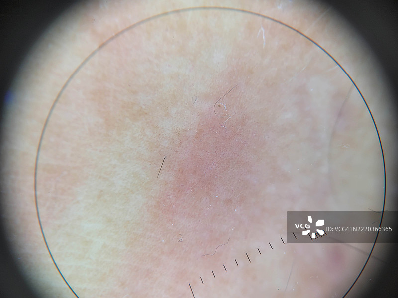 用于教育目的的皮肤病变的皮肤镜（放大）图像图片素材
