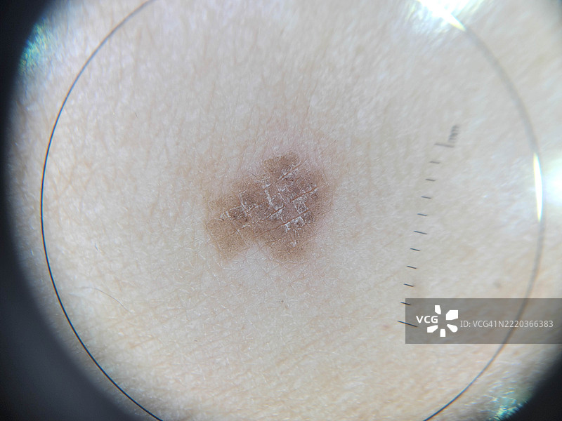 用于教育目的的皮肤病变的皮肤镜（放大）图像图片素材