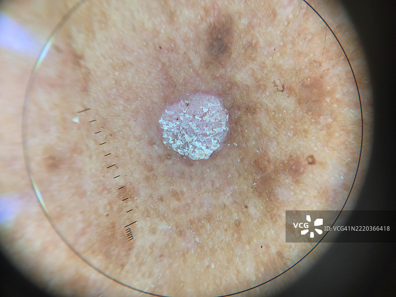 用于教育目的的皮肤病变的皮肤镜（放大）图像图片素材