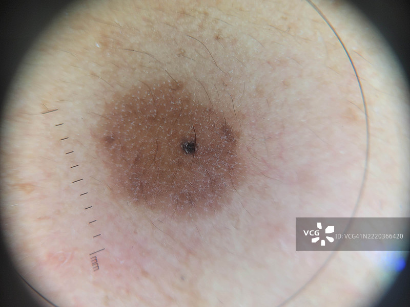 用于教育目的的皮肤病变的皮肤镜（放大）图像图片素材