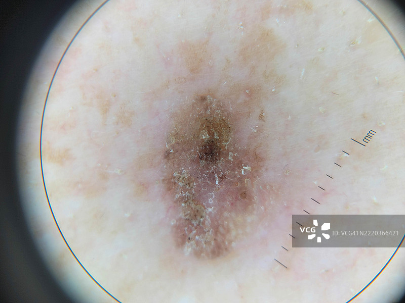 用于教育目的的皮肤病变的皮肤镜（放大）图像图片素材