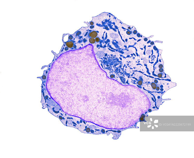 急性巨核细胞白血病图片素材