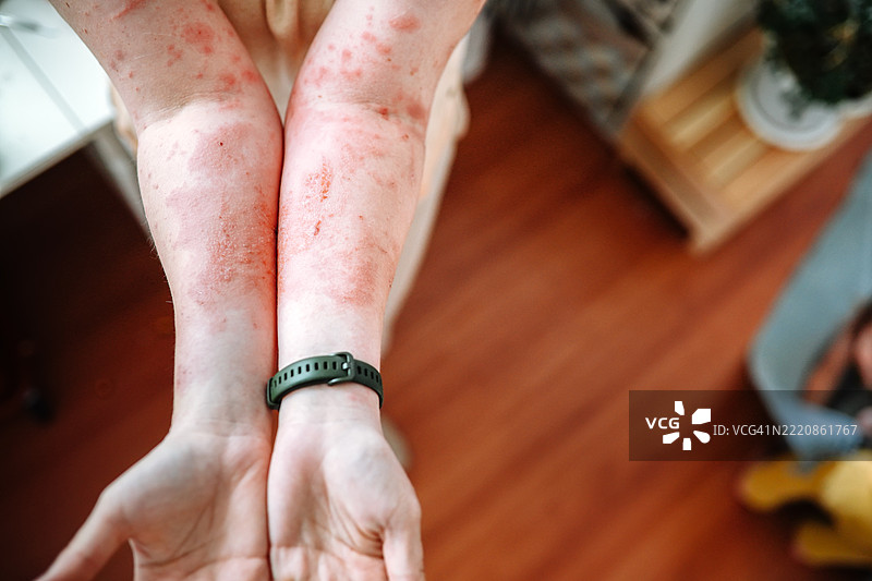 火灾处理的后果：受到巨型牛蒡影响的女性手部。图片素材