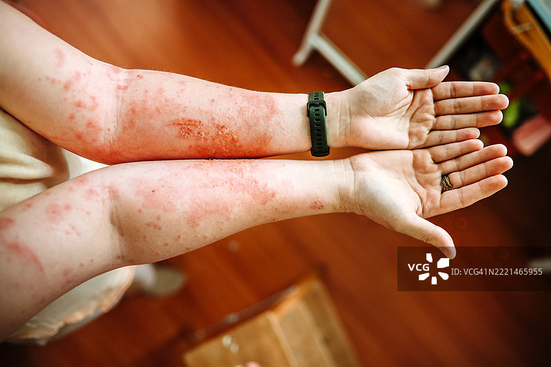 巨型牛蒡造成的毁灭性烧伤：一位丰满女性的手与大自然对抗。图片素材