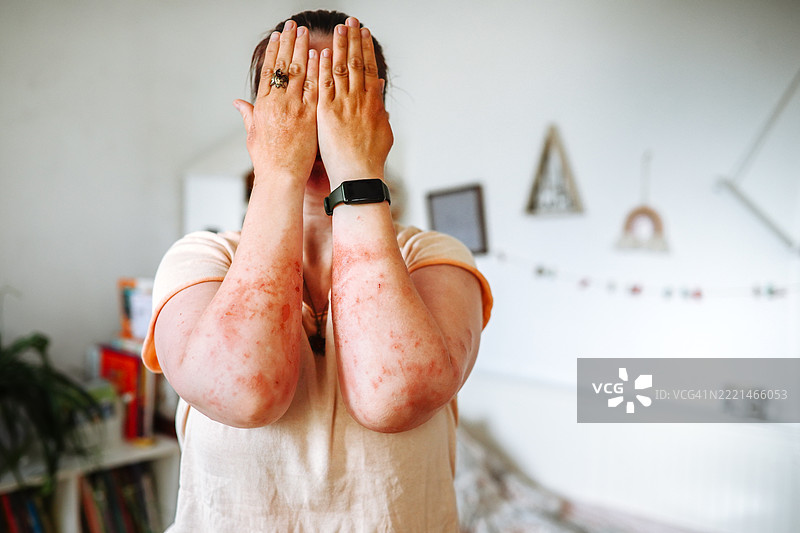 与巨型猪草作斗争后的后果：一位丰满女性的手被烧伤。图片素材