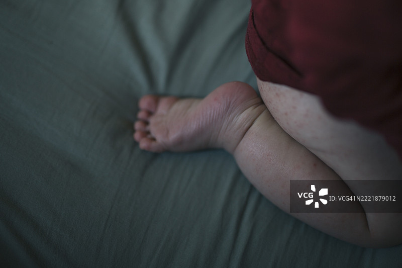 婴儿脚部皮肤过敏图片素材