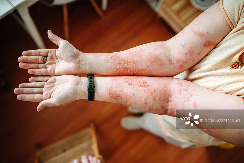 改变的手：阳光暴露和巨型牛蒡对一位丰满女性的影响。图片素材