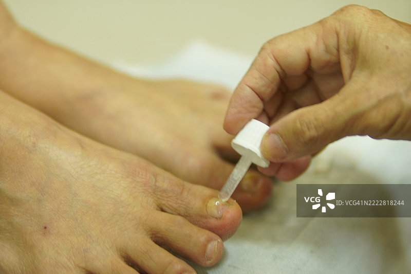 拇指上的真菌图片素材