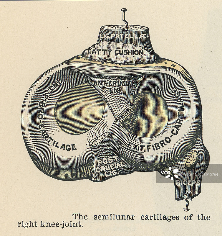 右膝关节的“半月板”的旧版雕刻插图，呈C形的纤维软骨垫位于股骨（大腿骨）和胫骨（小腿骨）之间。图片素材
