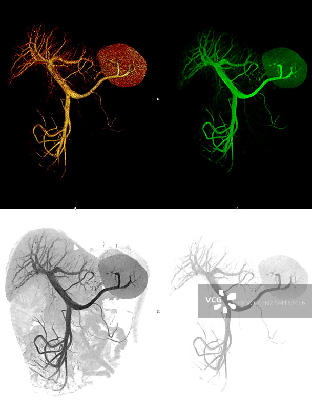 门静脉、脾静脉和肠系膜静脉的三维血管造影图图片素材