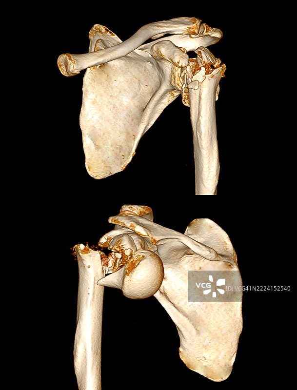 肩部骨折，CT扫描图片素材