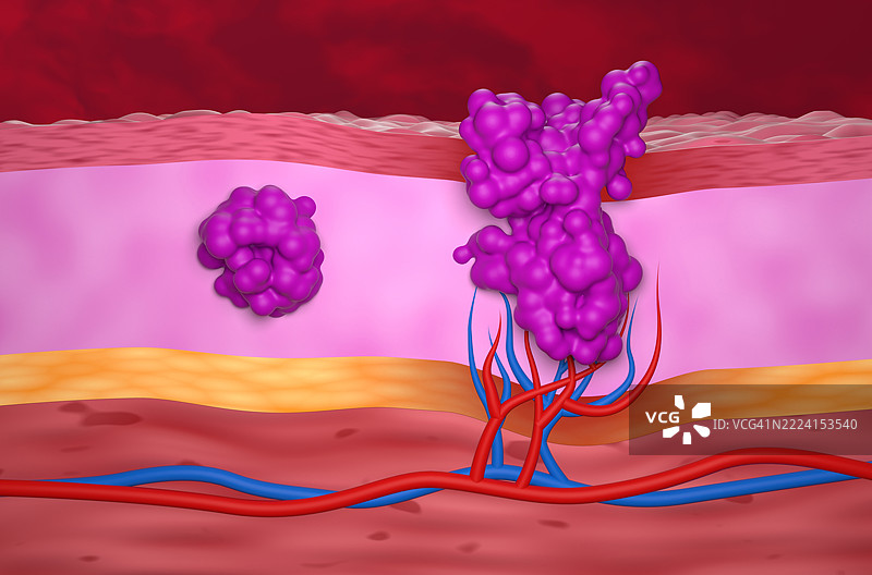 良性和恶性肿瘤插图图片素材