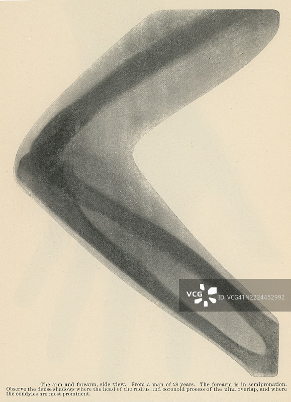 早期X光照片的老式雕刻插图，28岁男性的手臂和前臂（侧视图）图片素材