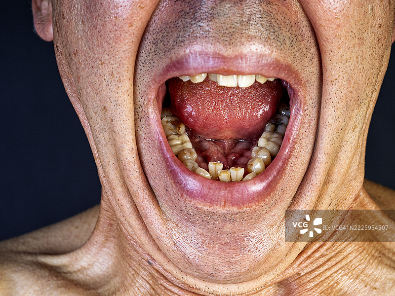 一名成年男子张嘴，牙齿畸形且肮脏，状况不佳。图片素材