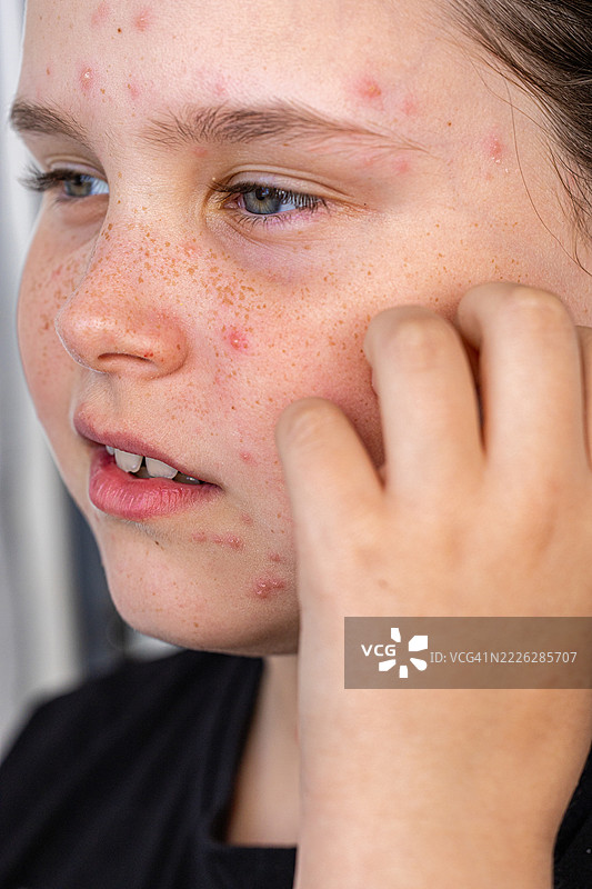 特写年轻面孔，带有雀斑和痘痘瑕疵图片素材