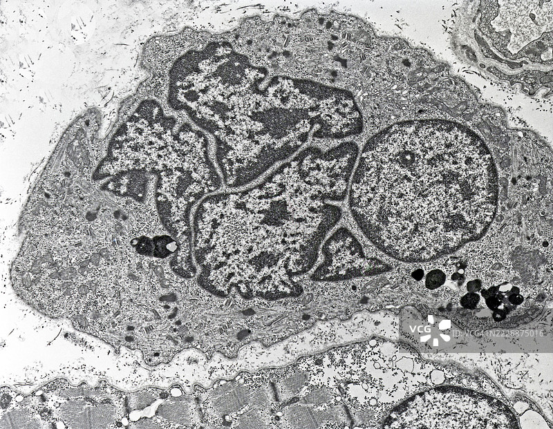 肌肉萎缩图片素材