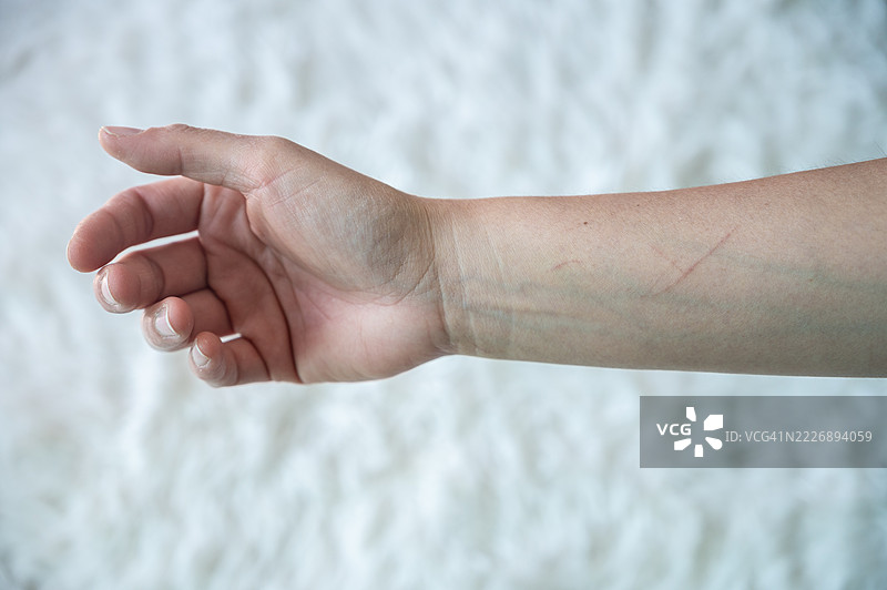 女性手臂上猫抓伤的特写镜头。猫抓伤和咬伤可能导致猫抓病。图片素材