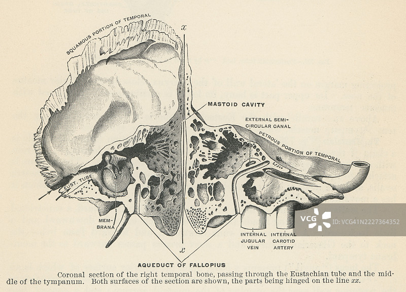 旧版雕刻插图的人耳 - 右侧颞骨的冠状切面穿过咽鼓管或咽鼓管，这是一个连接中耳与鼻咽（鼻后喉部的上部）的狭窄通道。图片素材