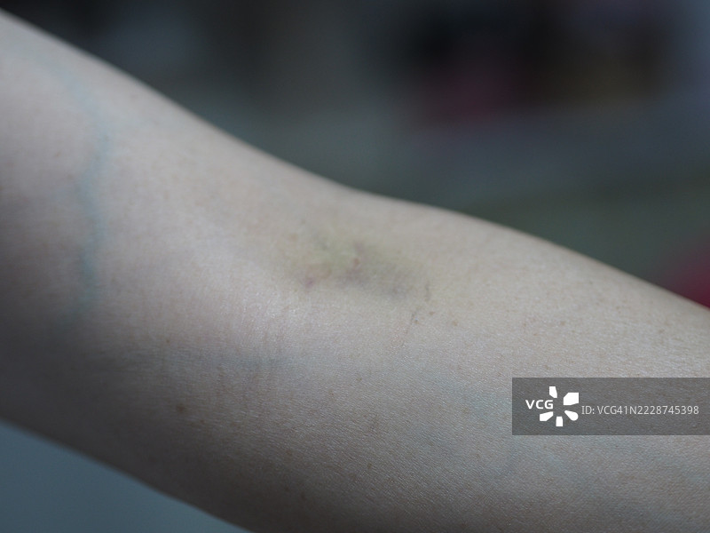 肘关节上的伤疤图片素材