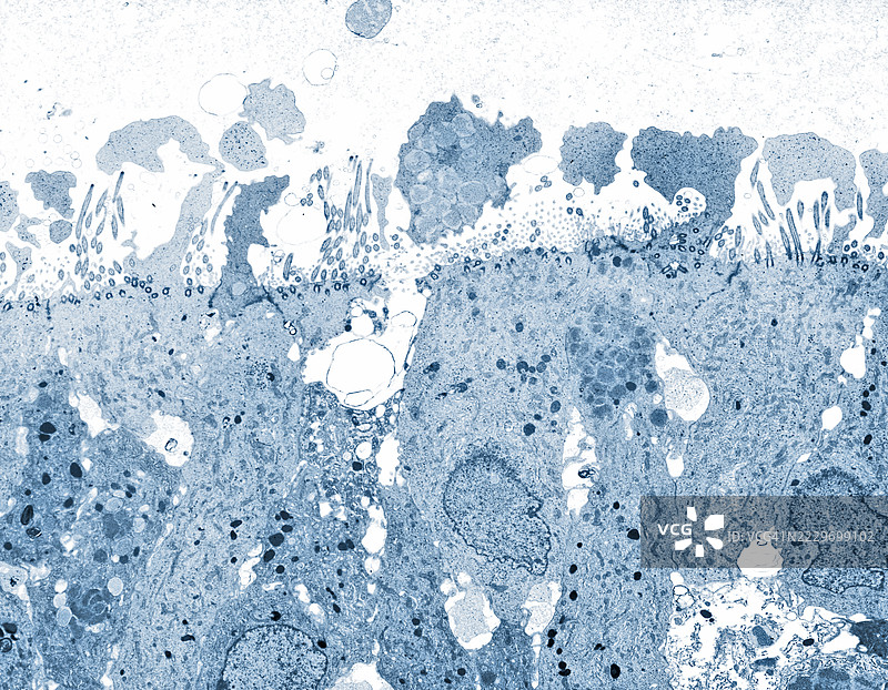 鼻窦纤毛柱状上皮细胞的异常图片素材