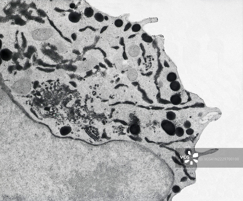 骨髓巨核细胞癌的氧化DAB染色图片素材