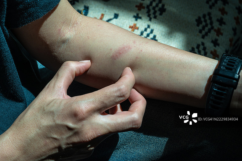 女人抓挠手臂的特写镜头，因为蚊子叮咬感到瘙痒。避免抓挠，因为这可能会加重刺激并可能导致感染。图片素材