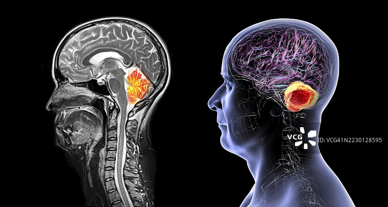 小脑MRI扫描插图图片素材