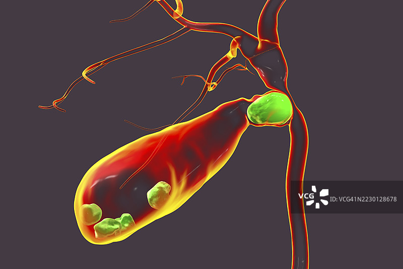 米里齐综合症插图图片素材