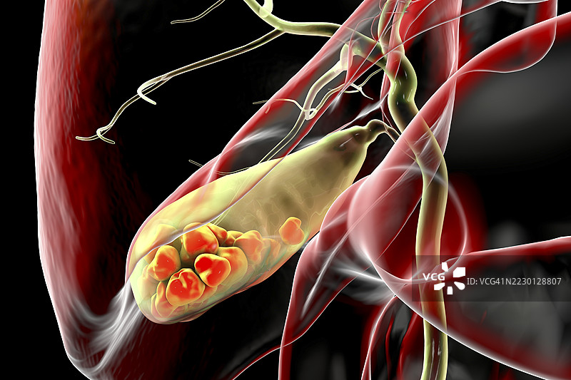 胆囊结石插图图片素材