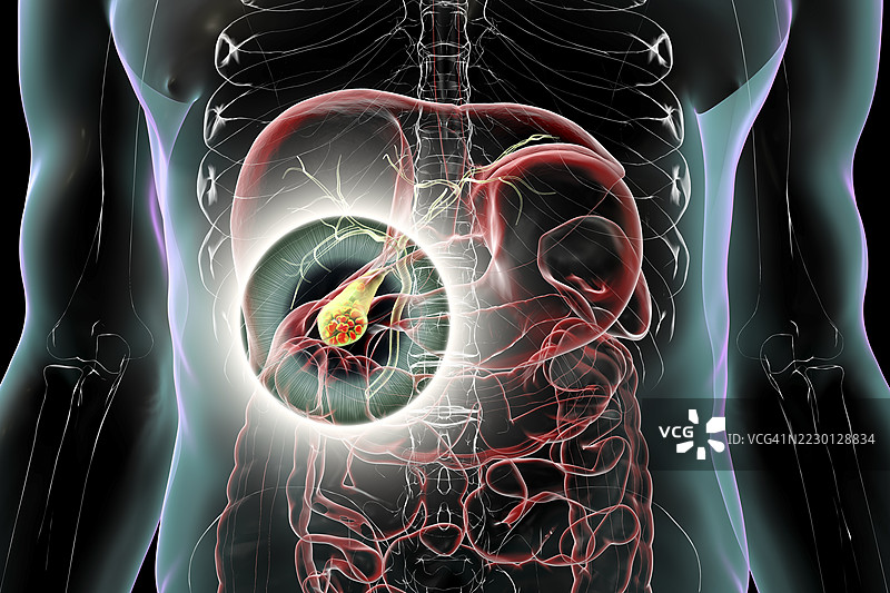 胆囊结石插图图片素材