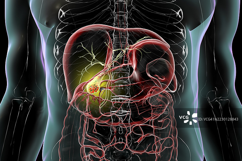 胆囊结石插图图片素材