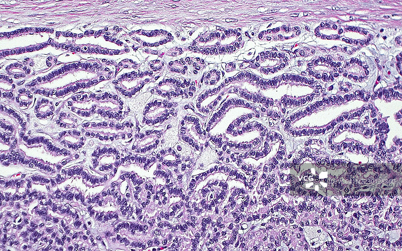 乳 头状肾细胞癌，光学显微镜图像图片素材