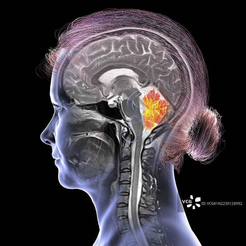 小脑MRI插图图片素材