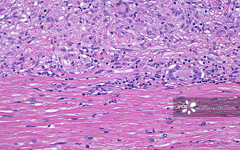 心脏肉芽肿病，光学显微镜图像图片素材