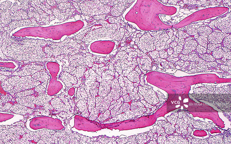 肾癌转移至骨骼的光学显微镜图像图片素材